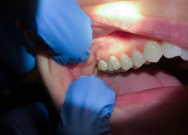 Best Broken or Chipped Tooth Repair in Rolesville, NC
