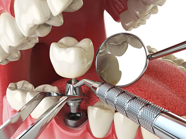 Best Emergency Wisdom Tooth Extraction in Rolesville, NC